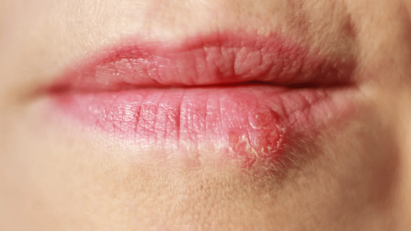 Viral Infection Treatment Descriptions at E-Health Network Virtual Care