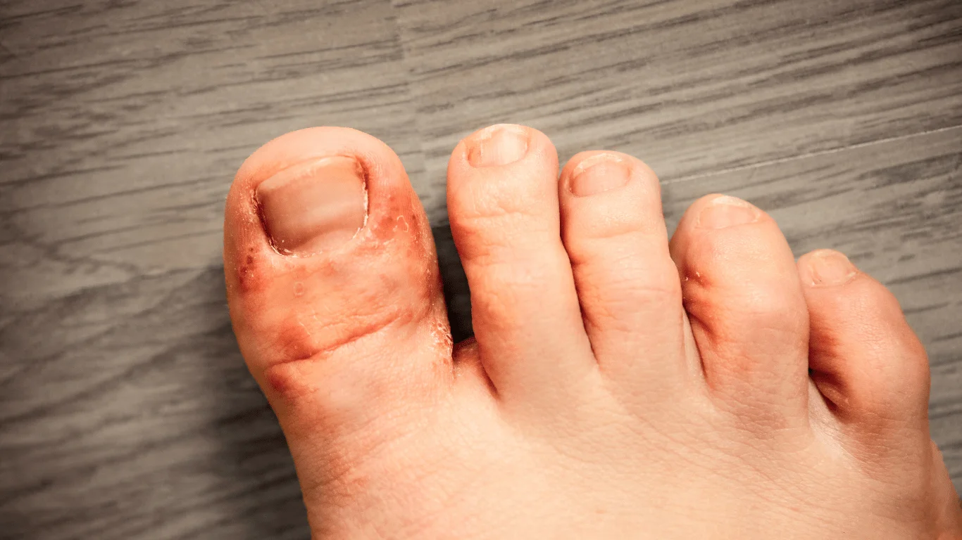 Fungal Infections Treatment Descriptions | E-Health Network Virtual Care