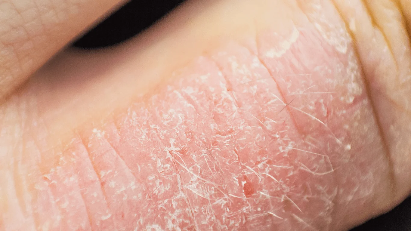Skin Conditions Treatment Descriptions | E-Health Network Virtual Care